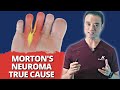 Everything you know about mortons neuroma is wrong surprising true causes revealed
