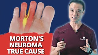 Everything You Know About Morton’s Neuroma Is WRONG! *Surprising True CAUSES Revealed*