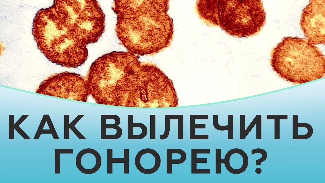 ᐈ Гонорея у Женщин | Признаки и Лечение Гонококковой Инфекции