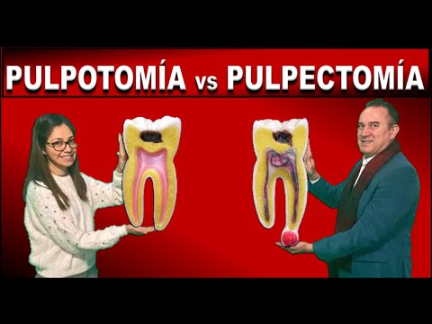 Video: Hoe om 'n pulpotomie op 'n permanente tand te doen?