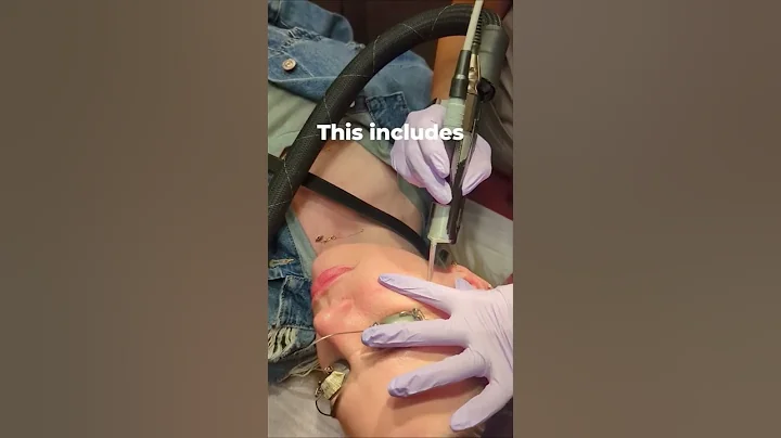 Cynergy Laser For Unsightly Broken Blood Vessels