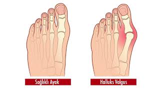 Halluks Valgus Nedir? - Op Dr Mehmet Burak Yalçın Ortopedi Ve Travmatoloji