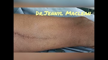 Nerve Stimulator Guided Lumbar and Sacral Plexus Block