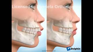 Murrieta Orthodontics Four-bicuspid extraction upper 1st lower 2nd