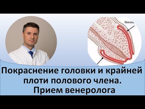 Покраснение головки и крайней плоти полового члена. Прием венеролога ...