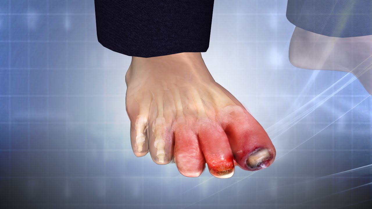 Swollen Big Toe: Causes, Symptoms, and Treatment Options