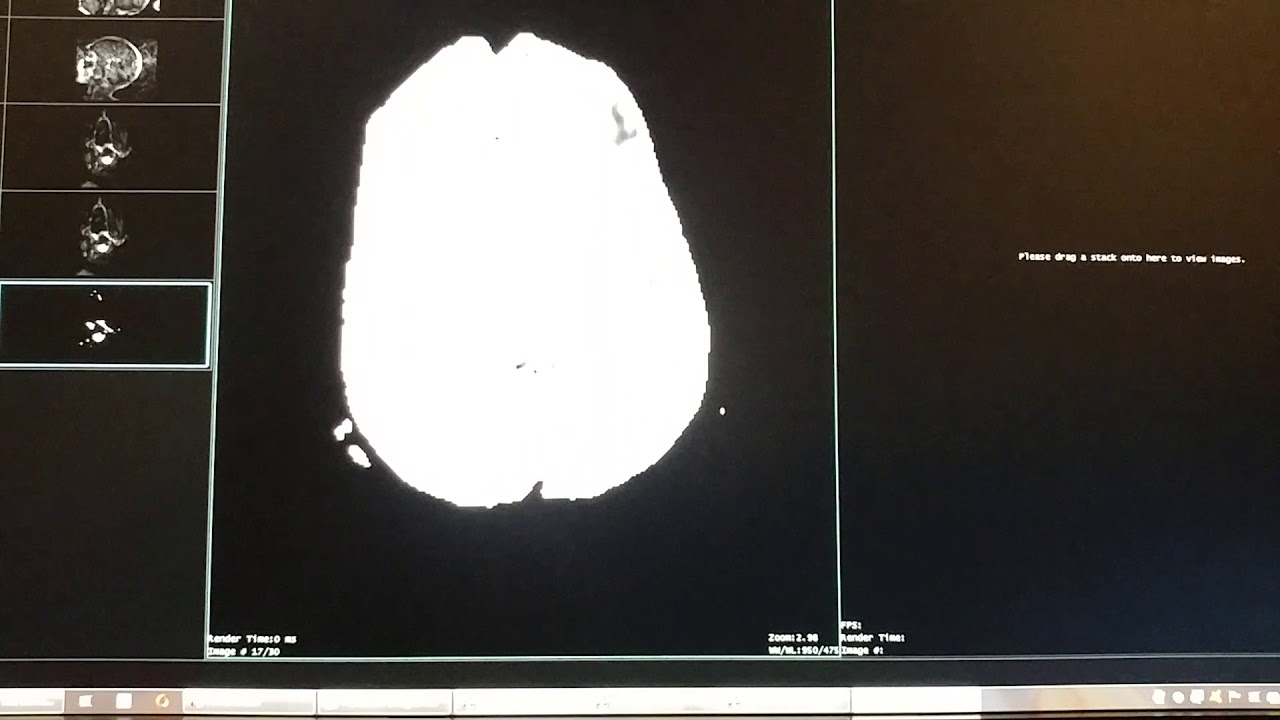 Diffüzyon MR Nasıl Yorumlanır (basit anlatım)