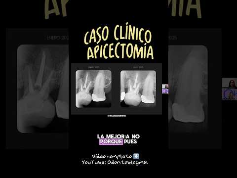 #casoclinico #apicectomia #apicectomia #endodoncia # #odontologia #microcirugiaapical #fyp