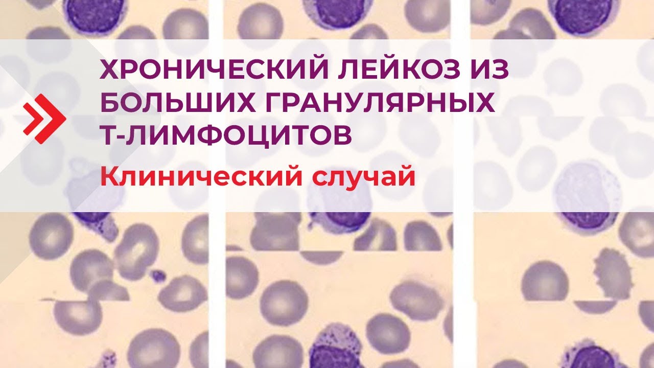 Хронический лейкоз из больших гранулярных Т-лимфоцитов. Клинический ...