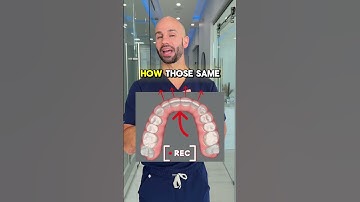 Correcting a deep bite because of extruded upper front teeth with Invisalign treatment.