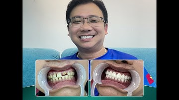 𝐁𝐈̣ 𝐌𝐀̂́𝐓 𝐑𝐀̆𝐍𝐆 𝐍𝐇𝐔̛𝐍𝐆 𝐕𝐀̂̃𝐍 𝐌𝐔𝐎̂́𝐍 𝐋𝐀̀𝐌 𝐑𝐀̆𝐍𝐆 𝐒𝐔̛́, 𝐂𝐎́ Đ𝐔̛𝐎̛̣𝐂 𝐊𝐇𝐎̂𝐍𝐆 ⁉️