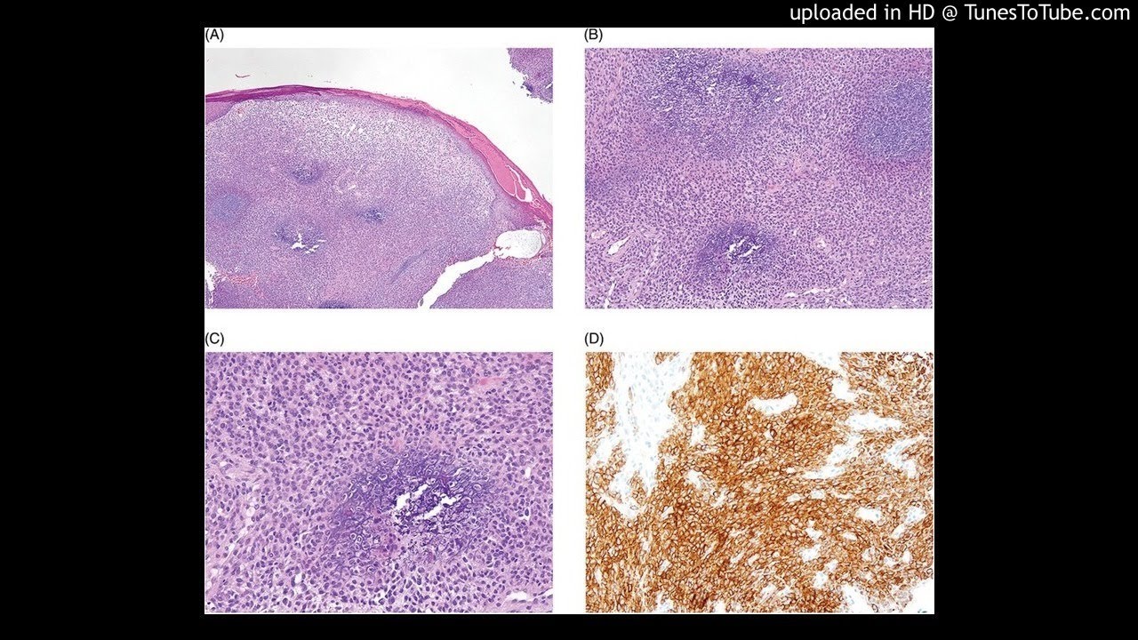 Epithelioid fibrous histiocytomas showing “chondroblastoma-like” calcification auf YouTube ansehen Epithelioid fibrous histiocytomas showing “chondroblastoma-like” calcification auf YouTube ansehen