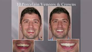 What is a Smile Makeover? | Orlando Smile Makeovers