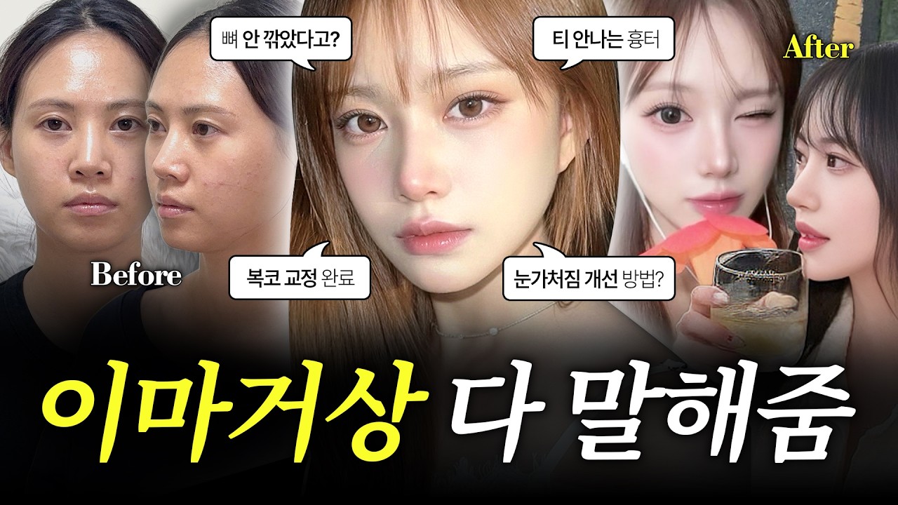 눈 재수술 고민했는데 이마거상?ㅣ코재수술 6개월 후기