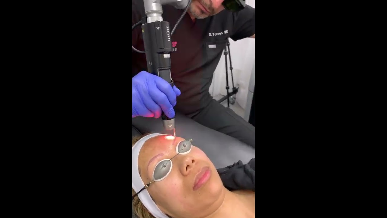 Melasma treatment San Diego with Picosure Focus at #skinandskinnier in La Jolla California - YouTube