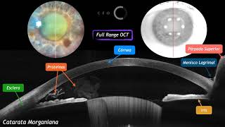 Multi CEO - Catarata Morganiana