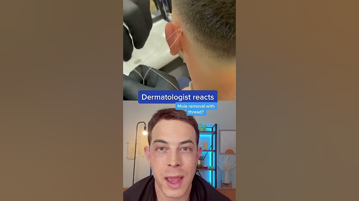 The wrong way to remove a mole | 208SkinDoc