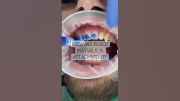 How we place Invisalign attachments or ‘buttons’… 🙌 #invisalign #newsmile #viral