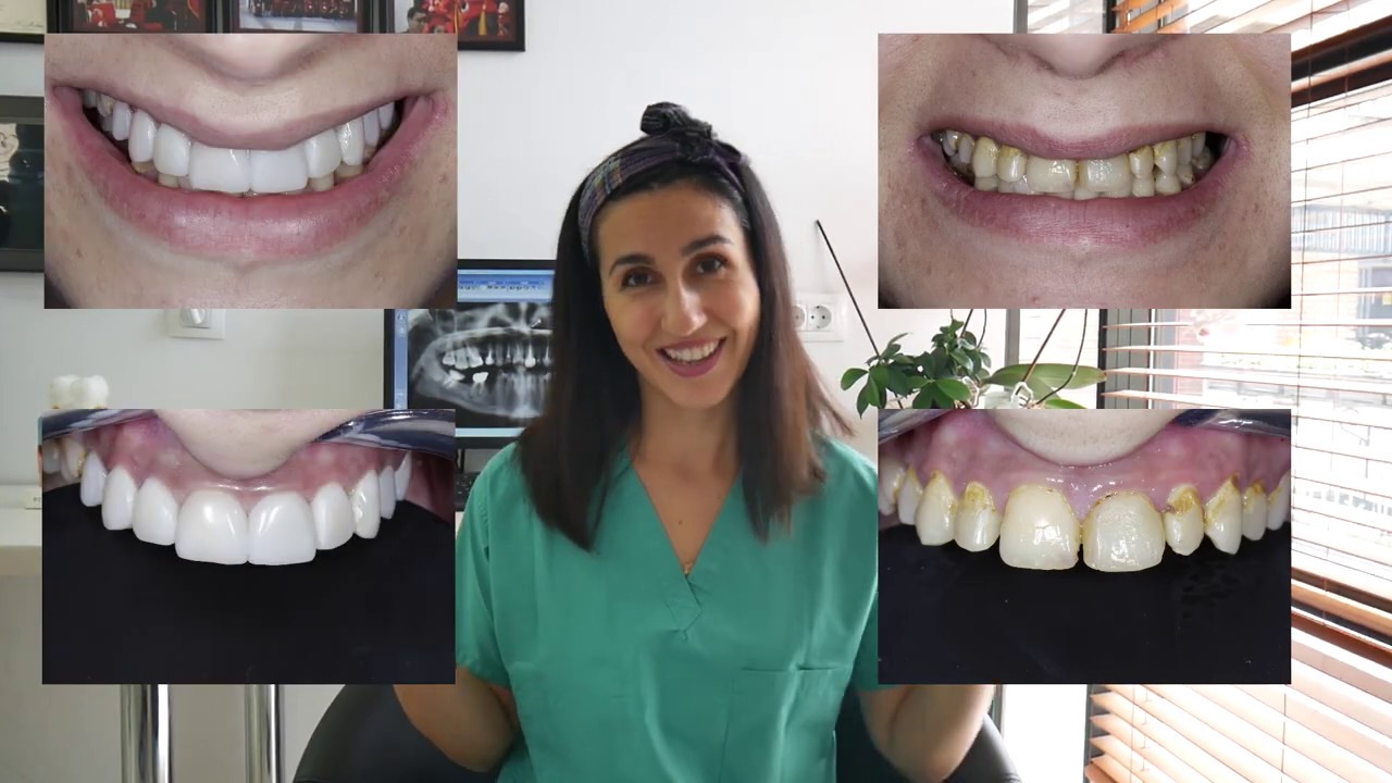 Same Day Smile Transformation NEW Case Composite Veneers