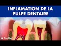 Pulpite  inflamation de la pulpe dentaire 