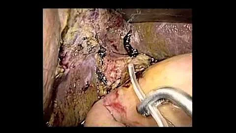 SS03 Best of Video I: V014. LAPAROSCOPIC WHIPPLE PROCEDURE WITH A 2-LAYERED PANCREATOJEJUNOS...