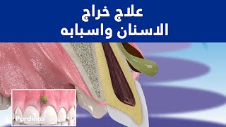 © علاج خراج الاسنان واسبابه