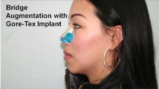 Asian Rhinoplasty Case Study | Dr. Buonassisi, 8 West Clinic in Vancouver British Columbia