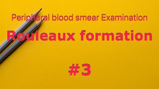Rouleaux formation | peripheral blood smear Examination | Hematology | Multiple Myeloma| ESR |