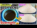 How I Got Rid Of My Back Acne Overnight  | Homemade Lotion To Remove Body Acne &amp; Reduce Acne Scars