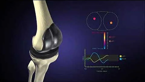TKR (Total Knee Replacement) Smart Knee Implant Vi...
