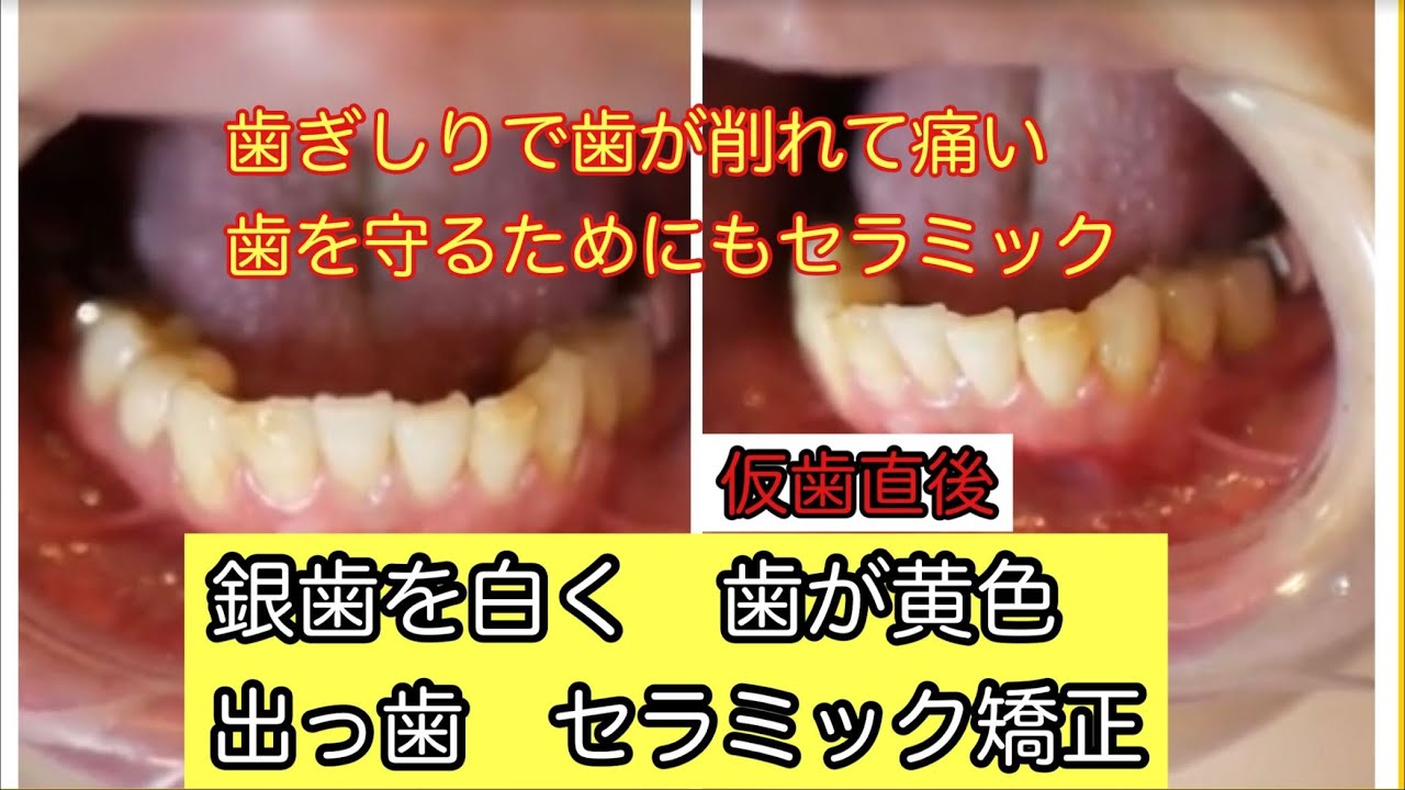 下の歯 セラミッククラウン 銀歯白くしたい 歯が黄色2 2 Youtube