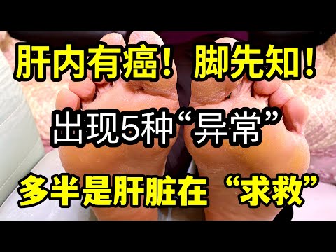 肝內有癌！腳先知！重視：若出現這5種“異常”，多半是肝臟在“求救”！ ！