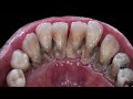 Mesmerizing Dental Cleaning: A Satisfying Watch