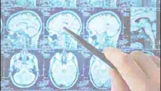 Good Brain Bad Brain Parkinsons Disease - Free Online Course On Futurelearncom