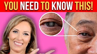 Cataracts 3 Tips You NEED to Know | Dr. Janine