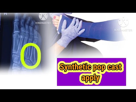How to apply pop cast|| How to apply pop cast 5th metatarsal fracture||