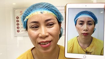 Loại Bỏ Nếp Mí Chồng Chéo Lên Nhau Bằng Kỹ Thuật Cắt Mí Mani Open Deep