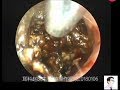 Earwax Removal Extraction,The first case of giant external auditory meatus cholesteatoma in 2018