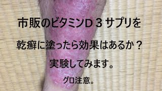 （乾癬）乾癬実験。乾癬にビタミンD３サプリを塗るとどうなる？グロ注意（psoriasis）（银屑病）