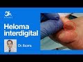Heloma Interdigital u Ojo de Gallo por el Dr. Iborra