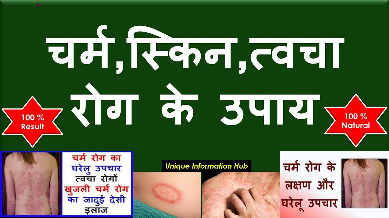 चर्म,स्किन,त्वचा रोग के उपाय ITwacha, Charm Rog, Skin Allergy