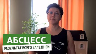 Абсцесс. Метод Лоскутовой справился с этим за 11 дней