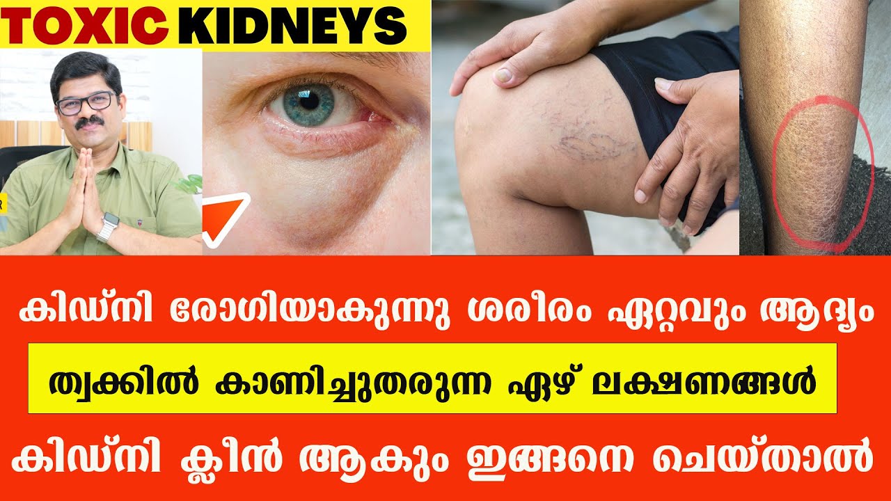 കിഡ്‌നി നശിക്കുന്നു ശരീരം ഏറ്റവും ആദ്യം ത്വക്കിൽ കാണിച്ചുതരുന്ന ഏഴ് ലക്ഷണങ്ങൾ /Dr Shimji