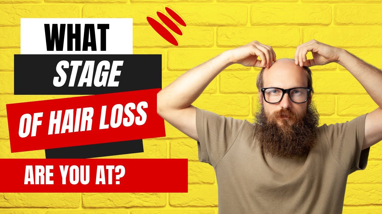 The Stages of Hair Loss Male Pattern Baldness YouTube