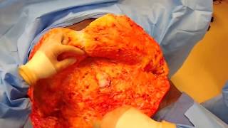 Female patient underwent a braline backlift and plus size tummy tuc...