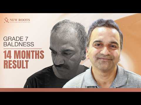 From Bald Scalp to Natural Hairline 😳 | 6000 Grafts Transformation | New Roots | Vashi | Navi Mumbai