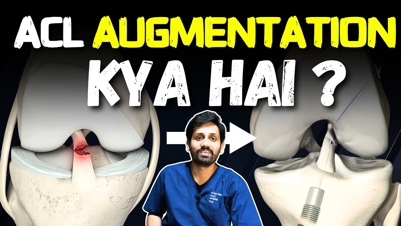 ACL Augmentation vs ACL Reconstruction: Key Differences. - YouTube