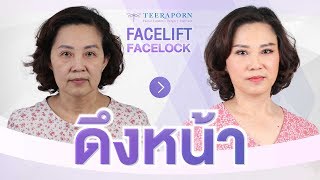 รีวิวดึงหน้า Facelift 12 วัน!!! อายุ 58 ปี เจาะครบทุกประเด็น