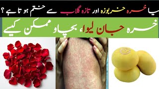 Measles Myths, Facts & Treatment What Parents Must Know Khasra Ka Ilaj