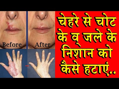 चेहरे से चोट के व् जले के निशान को कैसे हटाएं..|How To Remove scars